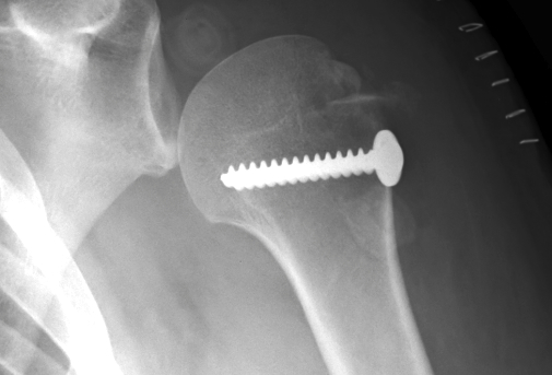 ORIF Greater Tuberosity Fracture